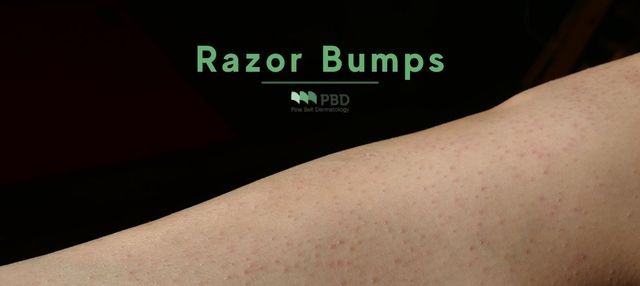 Shaving bumps deals on legs